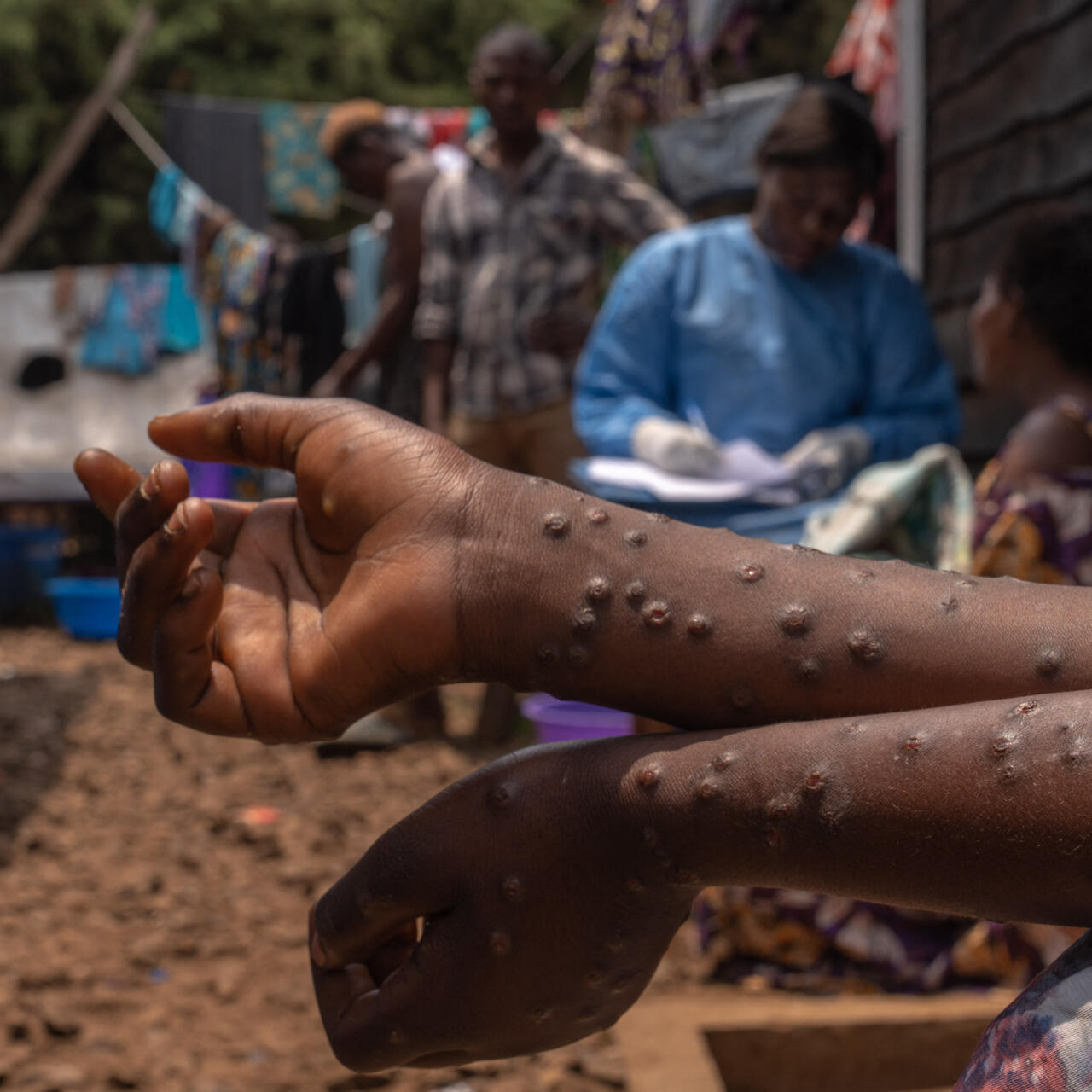Un patient souffrant de mpox est assis sur un banc de l'hôpital de Kavumu, à 30 kilomètres au nord de Bukavu, dans l'est de la RD Congo, le 24 août 2024. © Glody Murhabazi, AFP