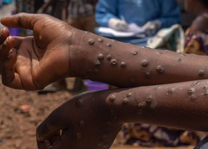 RDC : recul des cas de choléra et de Mpox, mais la vigilance sanitaire demeure