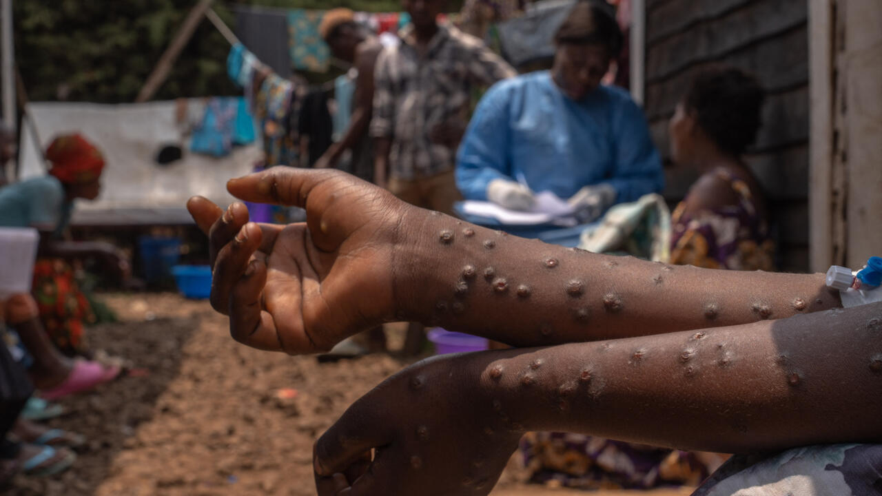 RDC : hausse des cas de choléra, la riposte contre le Mpox officiellement levée
